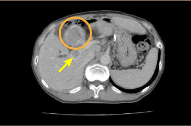 肝細胞がん症例CT画像（門脈浸潤例）