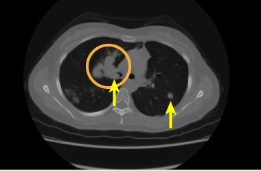 肝細胞がん症例CT画像（肺転移例）