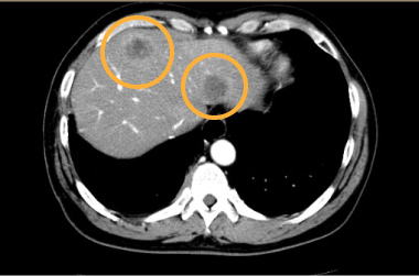 肺がん肝転移例