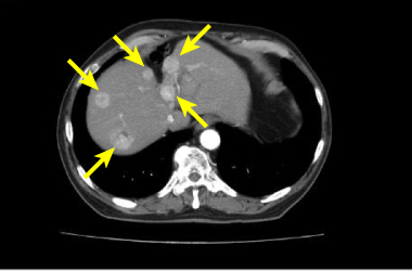 肝細胞がん症例CT画像（多発例）